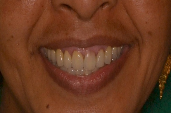 Full Mouth Rehabilitation at Simply Smiles Dental Clinic, Mumbai