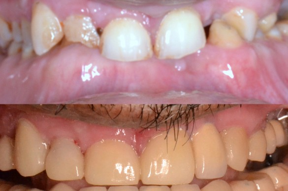Full Mouth Rehabilitation at Simply Smiles Dental Clinic, Mumbai