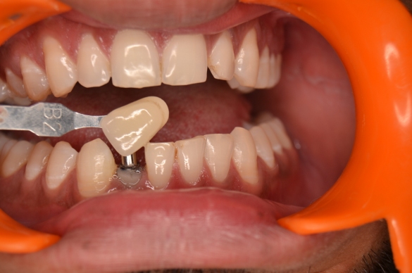 Dental Implant Process at Simply Smiles Dental Clinic, Mumbai