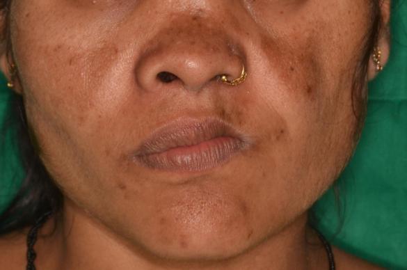 Maxillofacial Reconstructions at Simply Smiles Dental Clinic, Mumbai