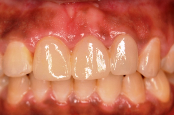 Periodontics at Simply Smiles Dental Clinic, Mumbai