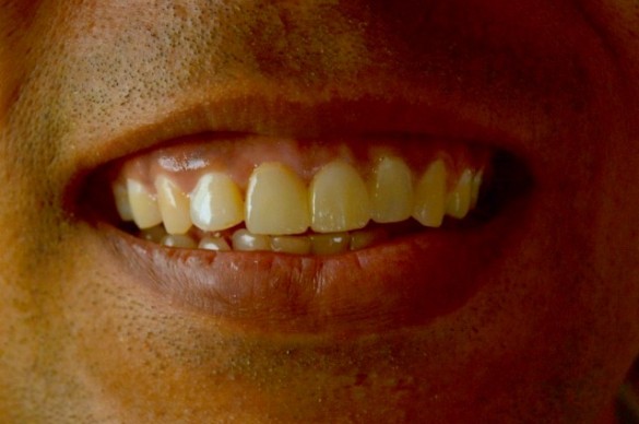 Smile Design at Simply Smiles Dental Clinic, Mumbai