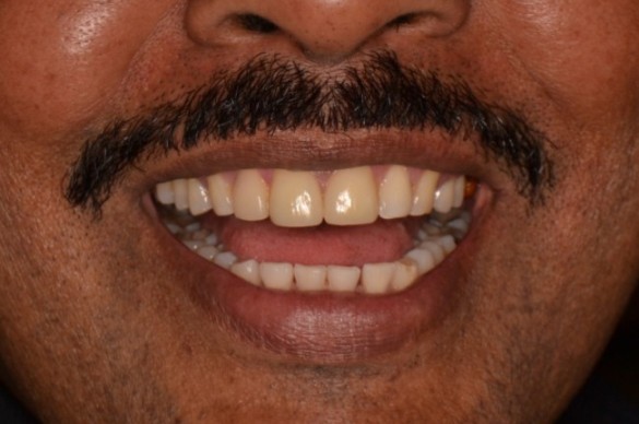 Space Closure - Cosmetic Dentistry at Simply Smiles Dental Clinic, Mumbai