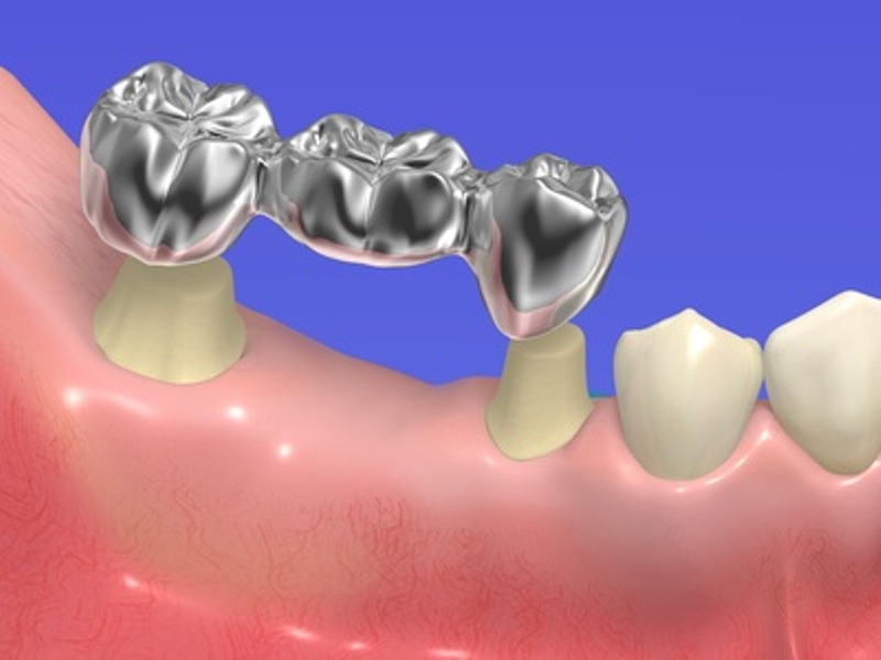 Dental Brides at Simply Smiles Dental Clinic, Mumbai