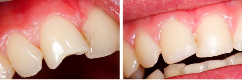 Composite Bonding at Simply Smiles Dental Clinic, Mumbai