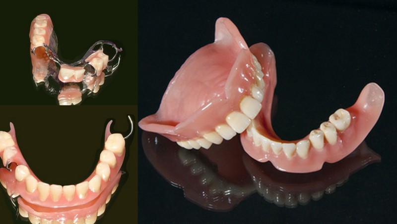 Dentures at Simply Smiles Dental Clinic, Mumbai
