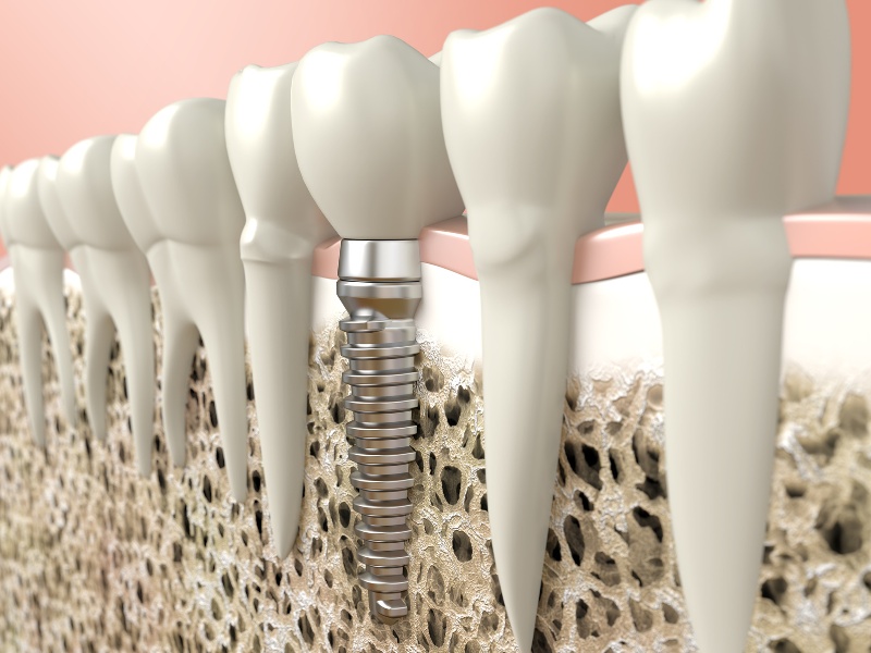 Dental Implants at Simply Smiles
