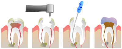Root Canals at Simply Smiles Dental Clinic