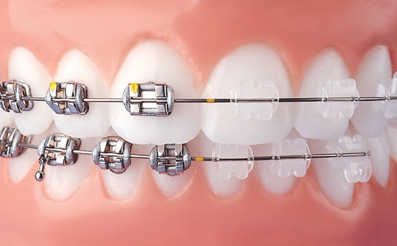 Visible Braces - Metal or Ceramic - at Simply Smiles Dental Clinic, Mumbai